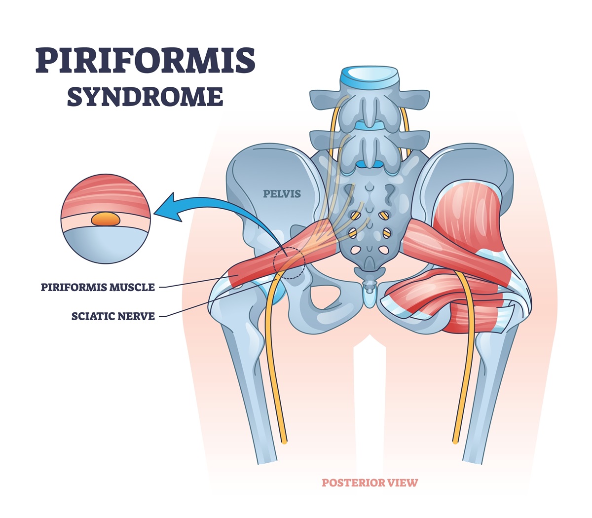 Piriformis syndróm, anatómia a nervus ischiadicus